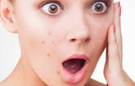 ব্রণ নিয়ে ভাবনা?