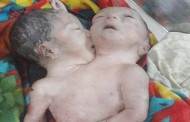পেট-বুক জোড়া লাগানো জমজ শিশু